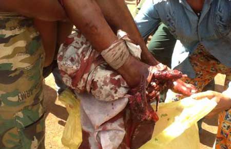 បុរស​ជាន់មីន​ស្គរ​ផ្ទុះ​ដាច់​ជើង ពេល​នាំ​កូន​ទៅ​រក​ឈើ​នៅ​ក្បែរ​ជើងភ្នំ​